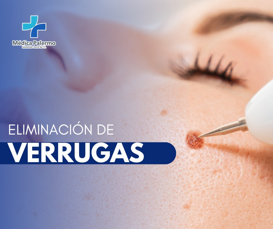Eliminación de verrugas